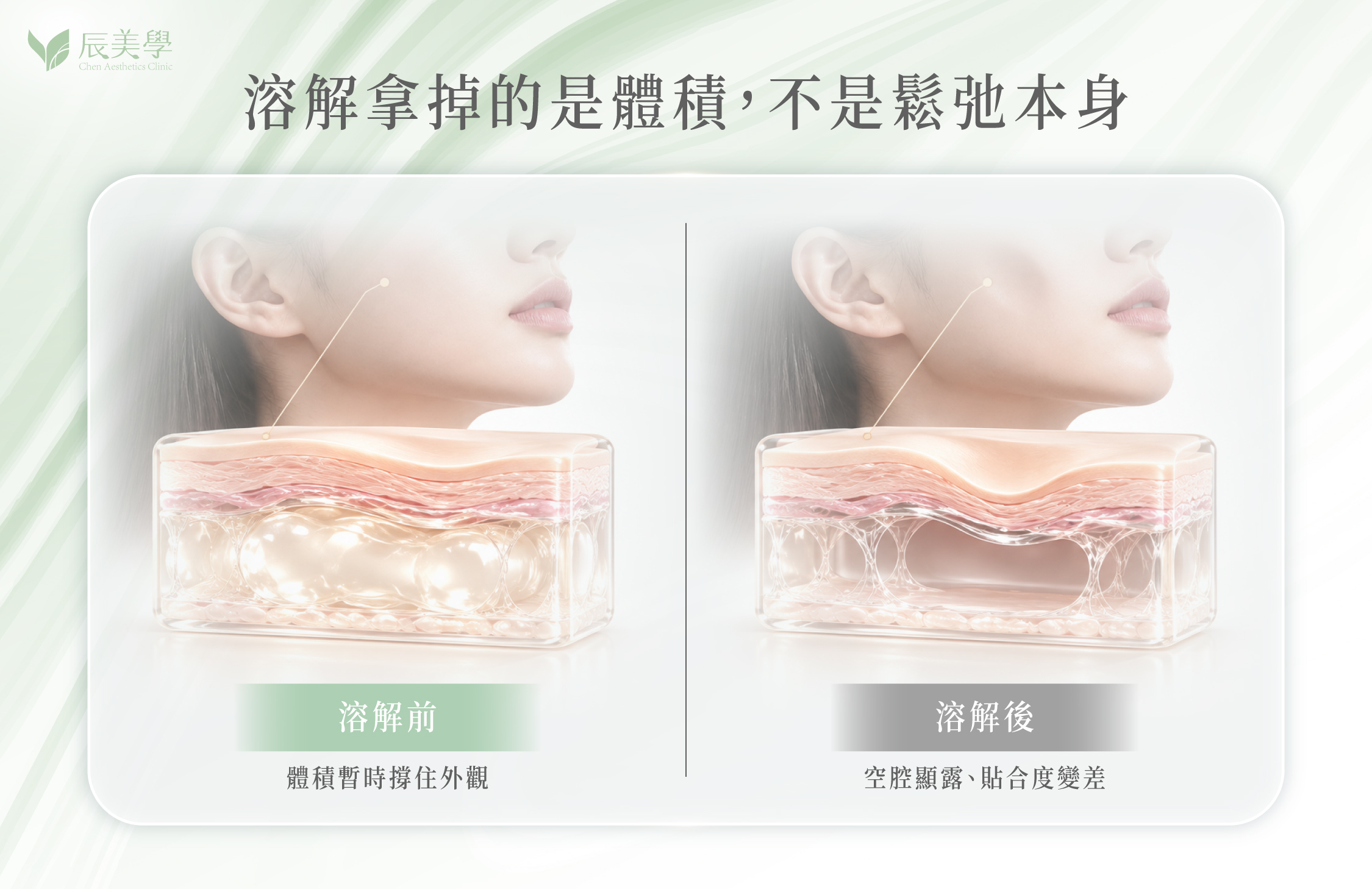 玻尿酸酶溶解前後皮下空腔對比示意圖＿辰美學