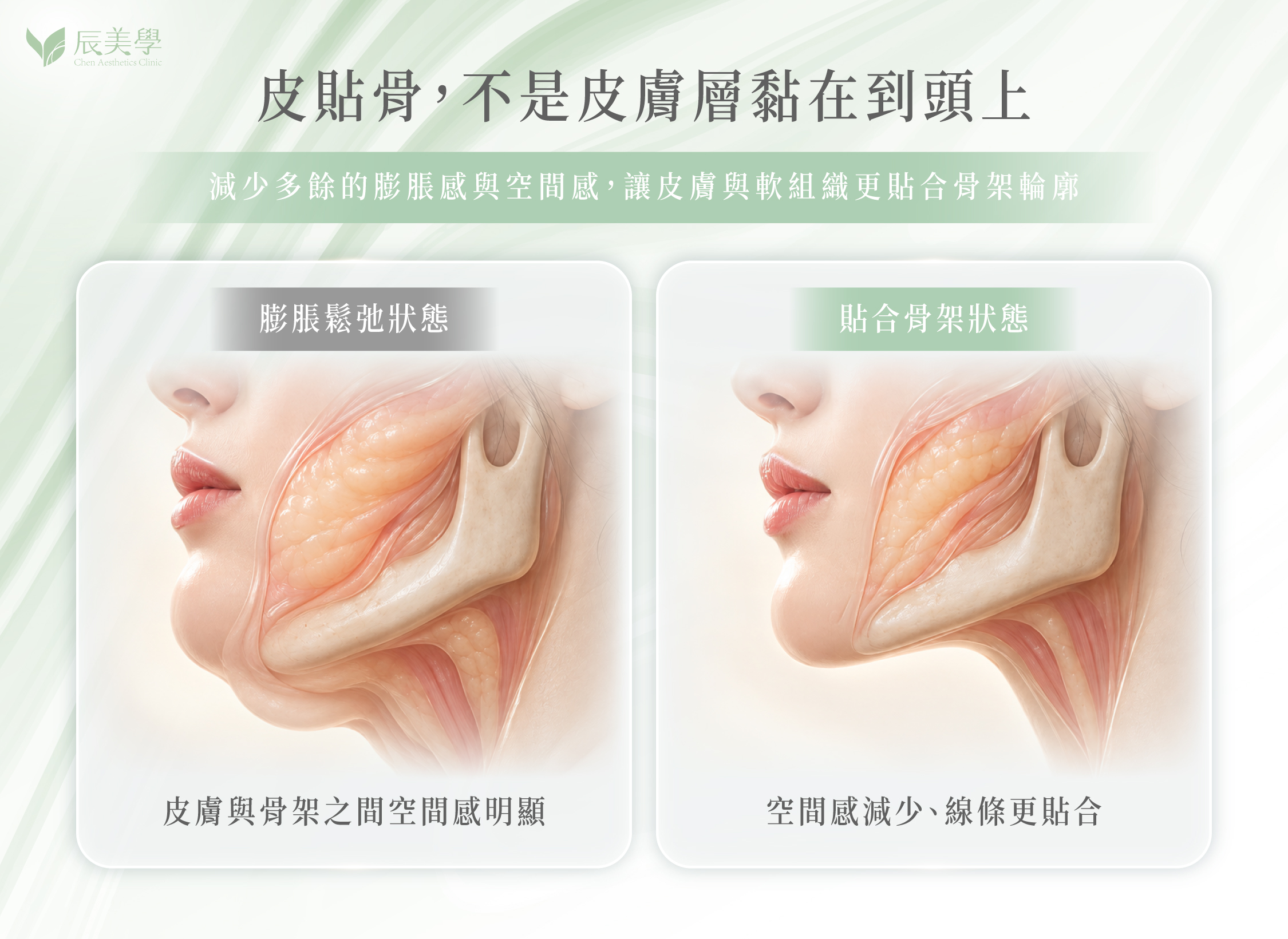 皮貼骨概念示意圖：皮膚與軟組織貼合臉部骨架＿辰美學