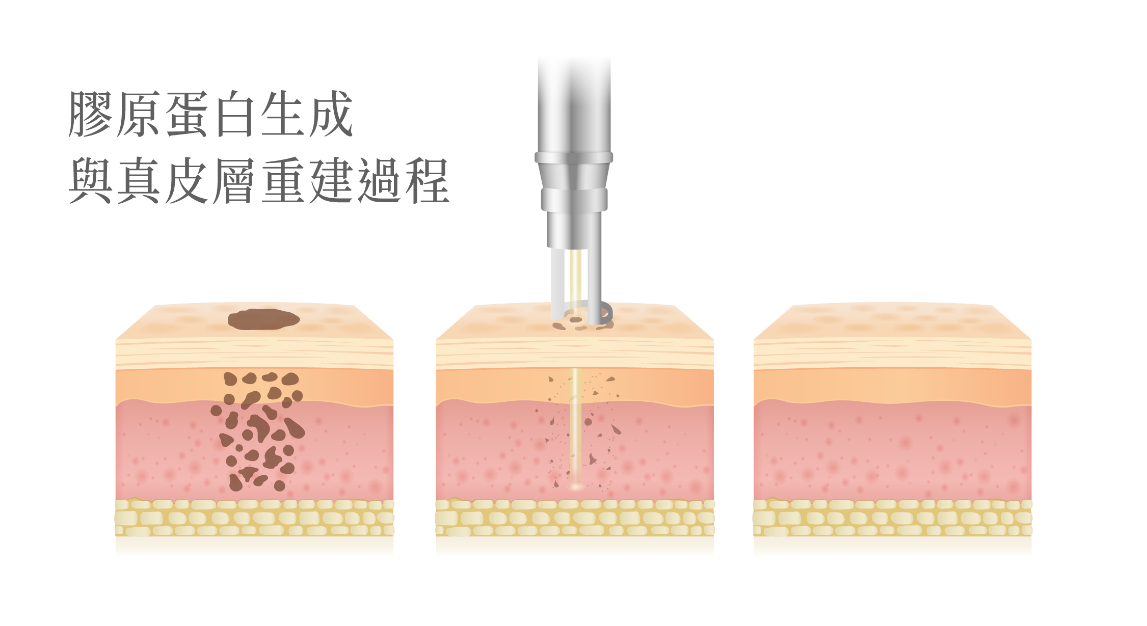 Picosure 755蜂巢皮秒＿辰美學