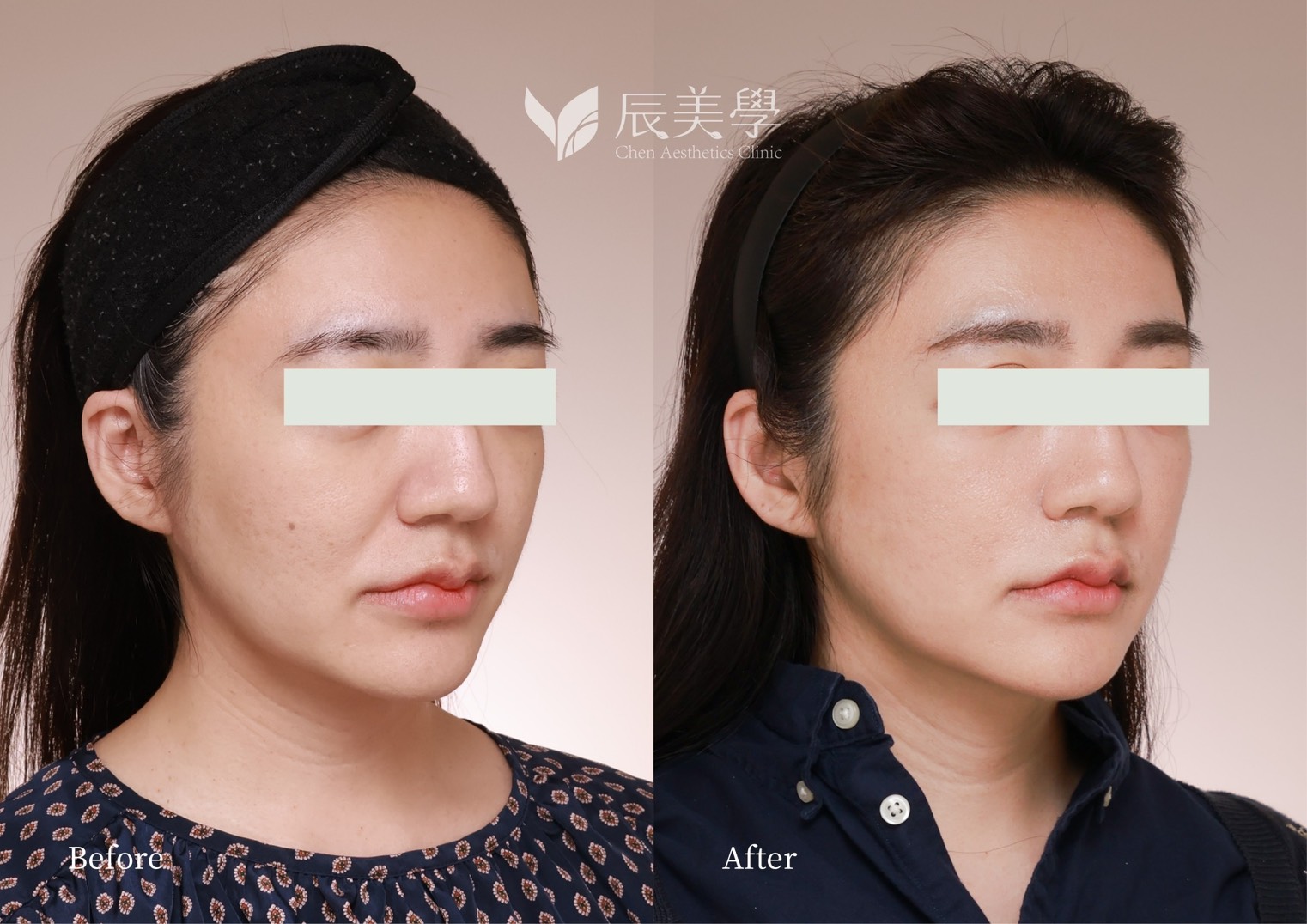 秘線逆向拉提＿辰美學