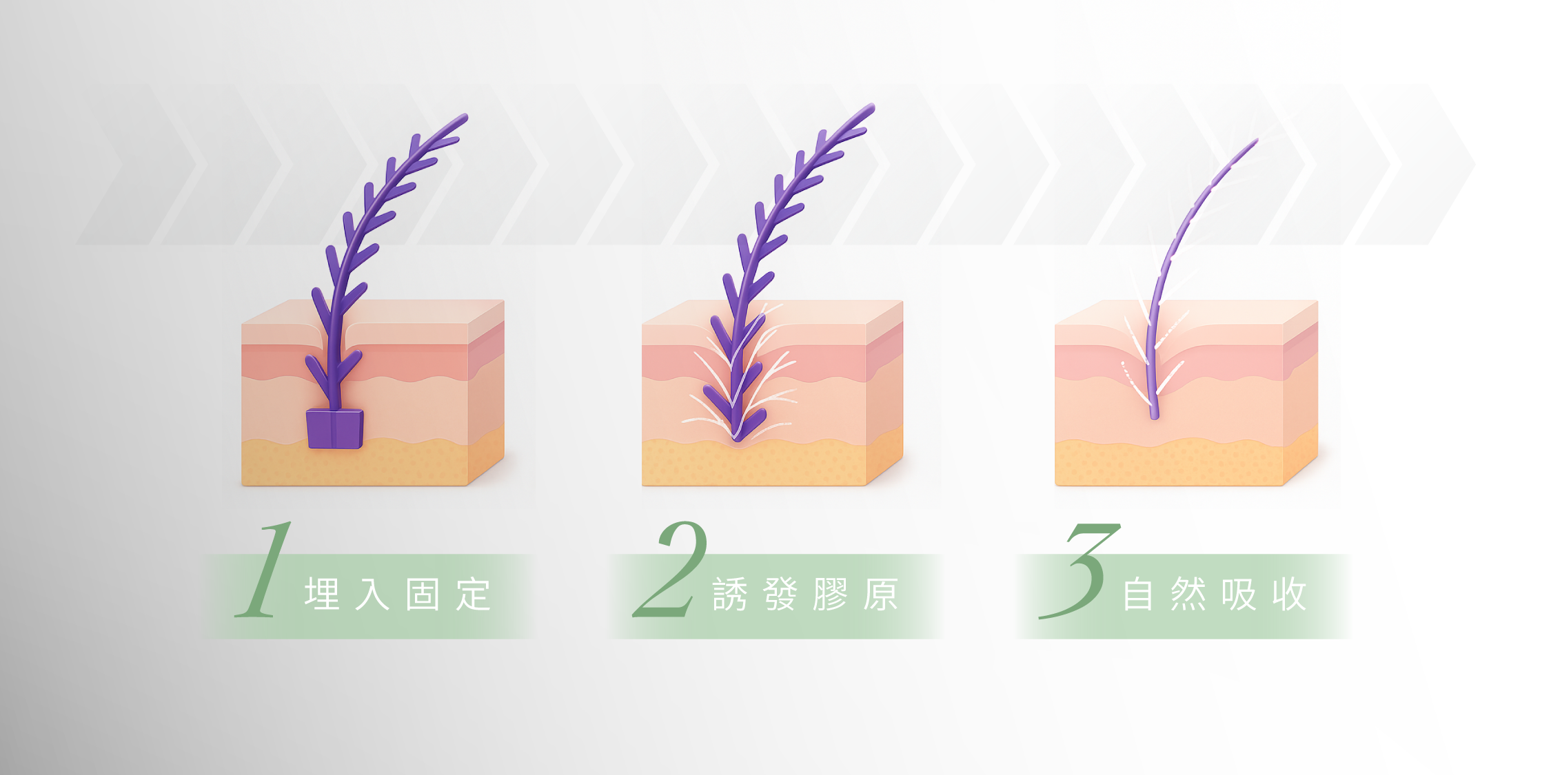 藍鑽魚骨線_辰美學