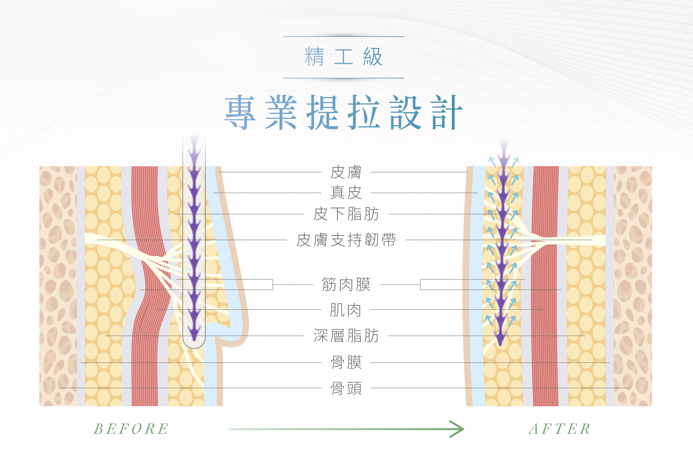 藍鑽魚骨線提拉設計_辰美學