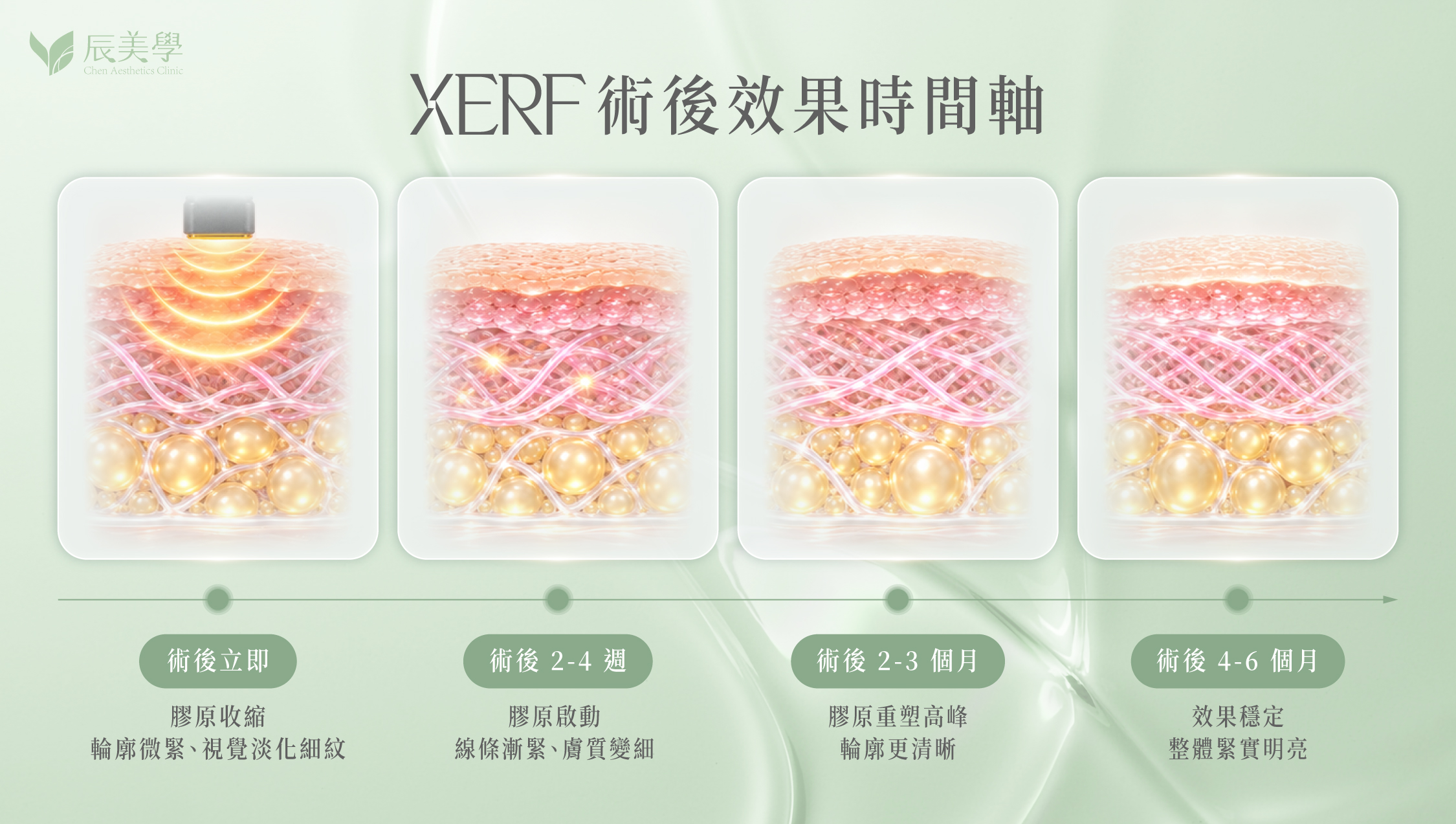 XERF 術後效果時間軸示意圖，呈現膠原蛋白新生與緊緻感的階段變化