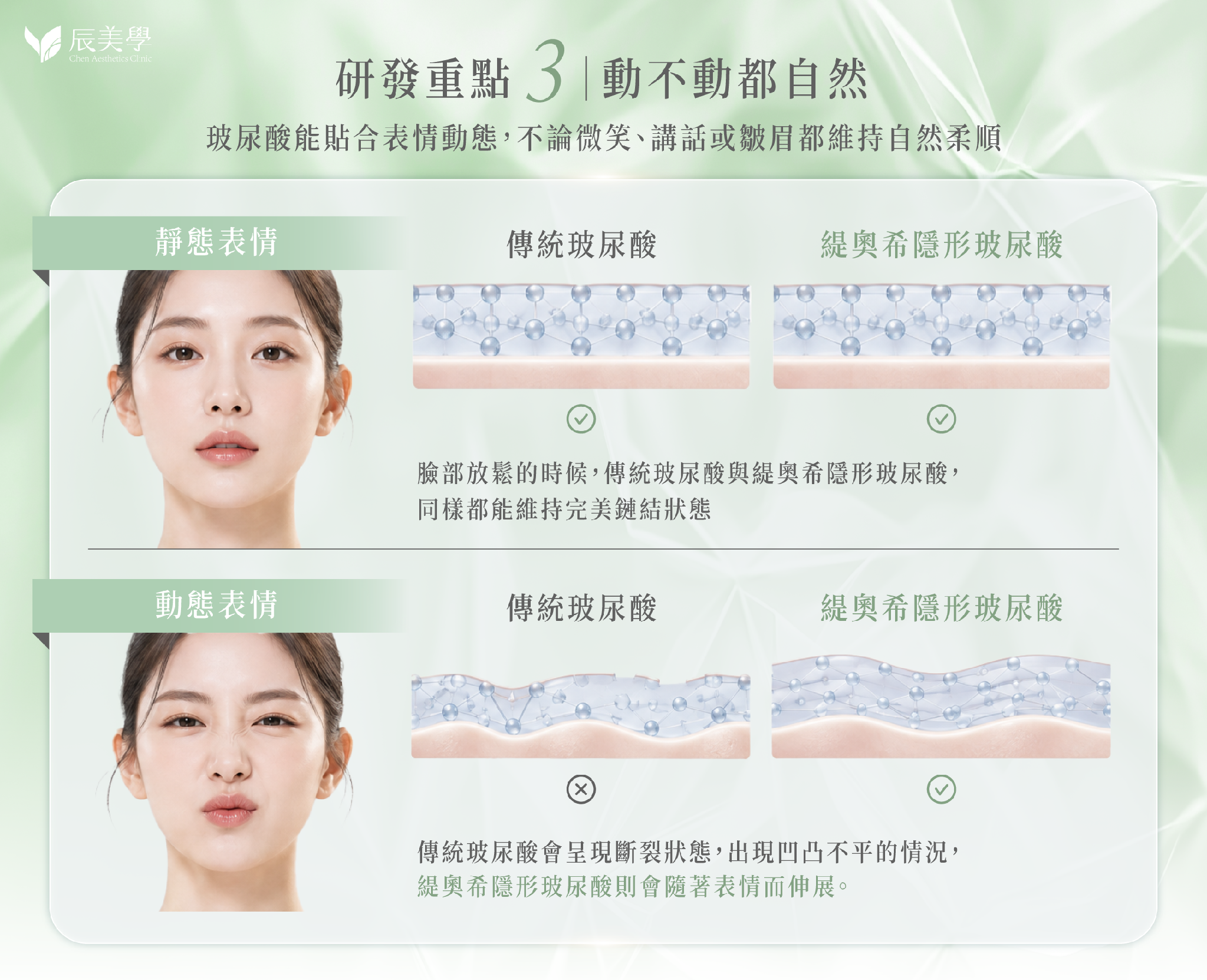 ▲ 動態表情下傳統玻尿酸易斷裂凹凸不平；緹奧希隱形玻尿酸則能隨表情自然伸展