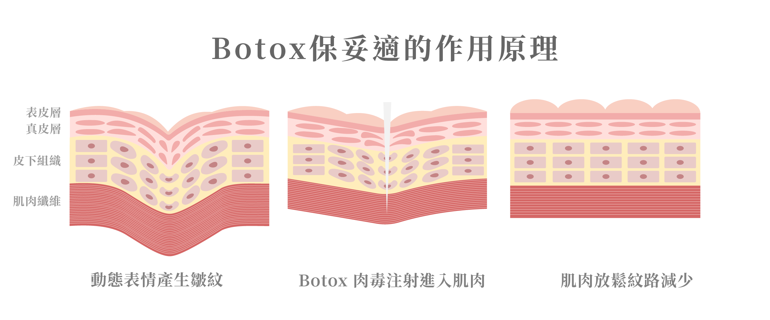 botox作用原理＿辰美學