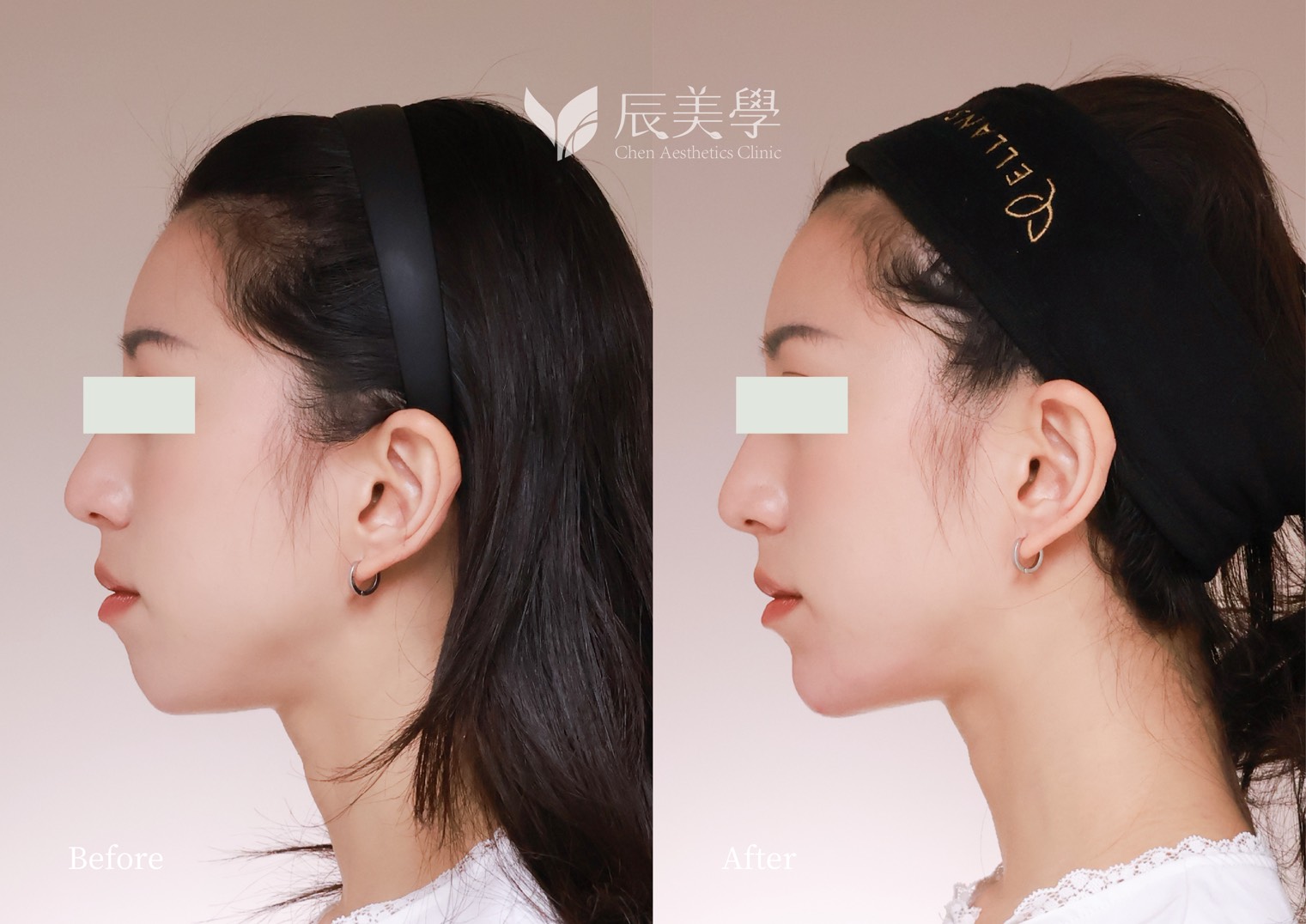 再生針＿辰美學