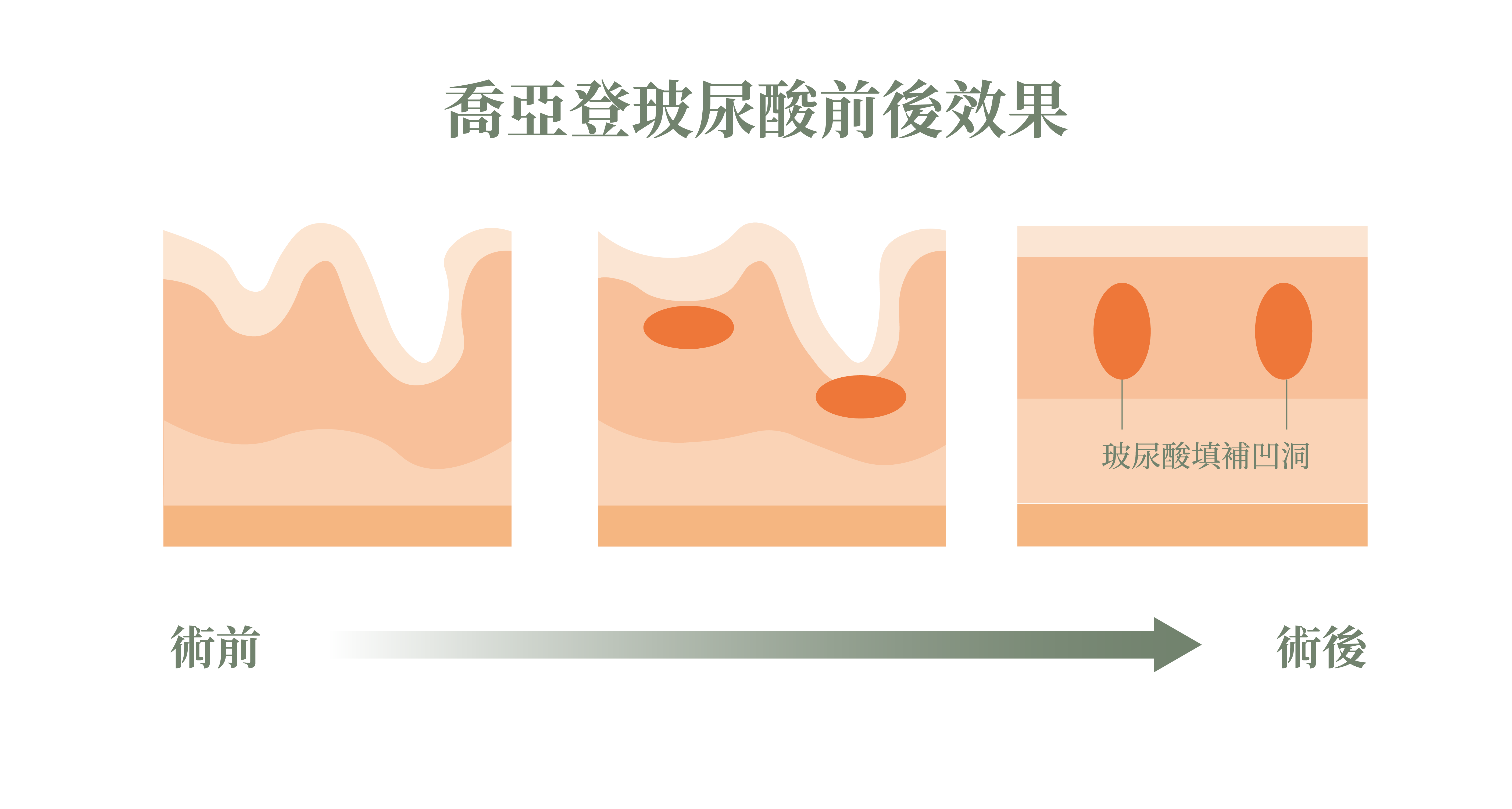 喬雅登玻尿酸前後效果比較_辰美學