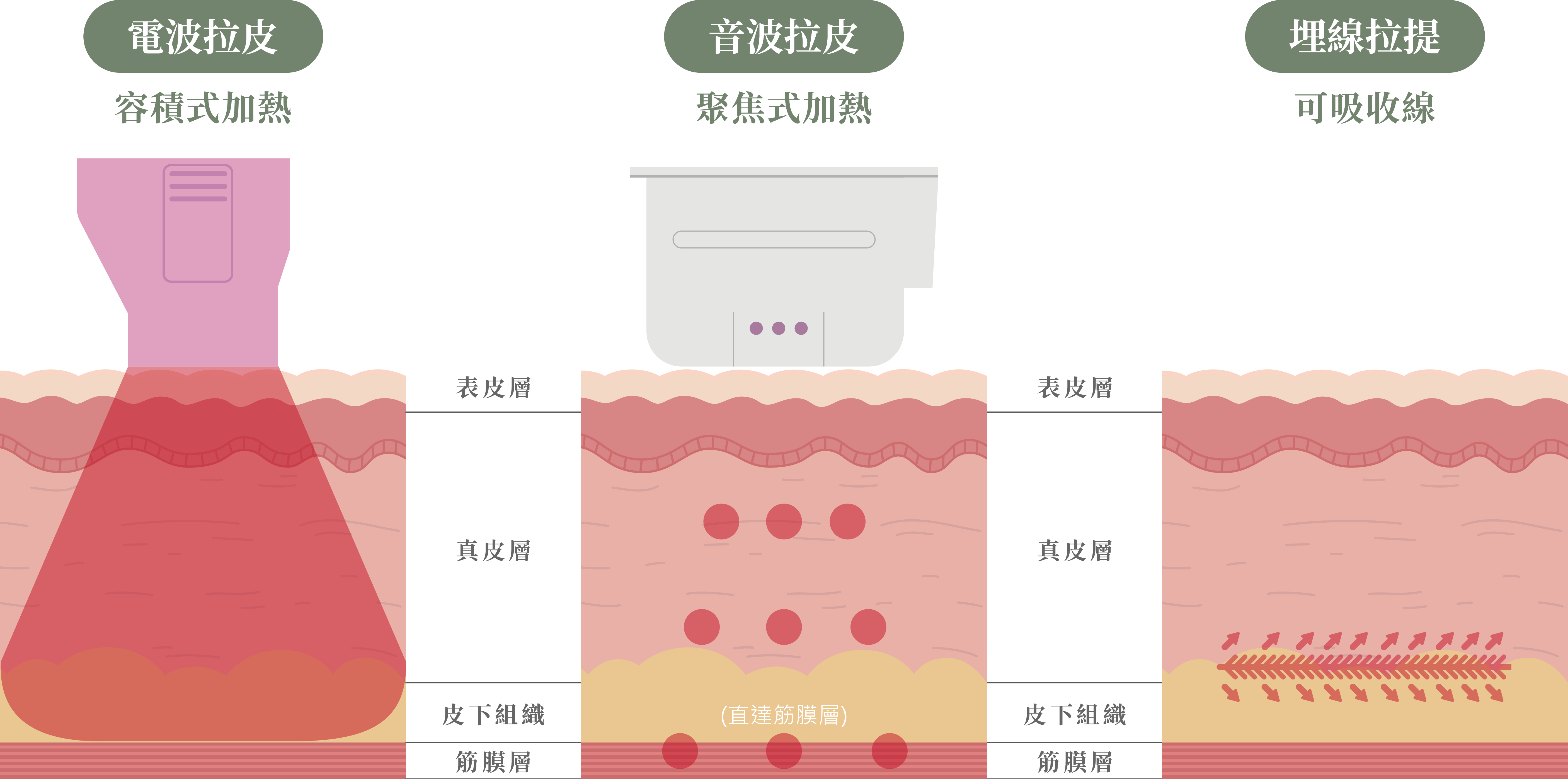 鳳凰電波、音波、埋線拉提差異＿辰美學