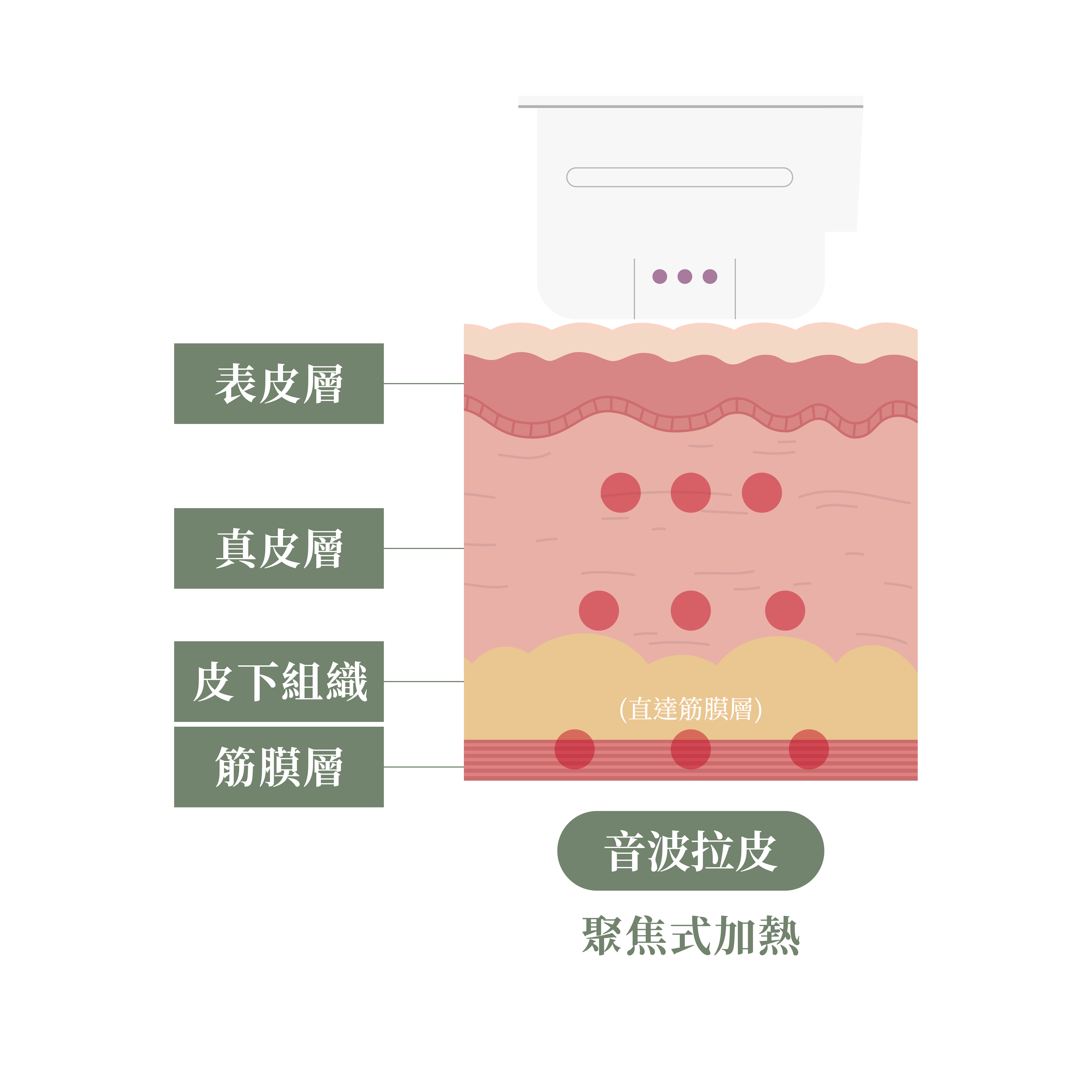 皮膚橫切面示意圖：真皮層、皮下層、SMAS 層與聚焦能量點分布。＿辰美學