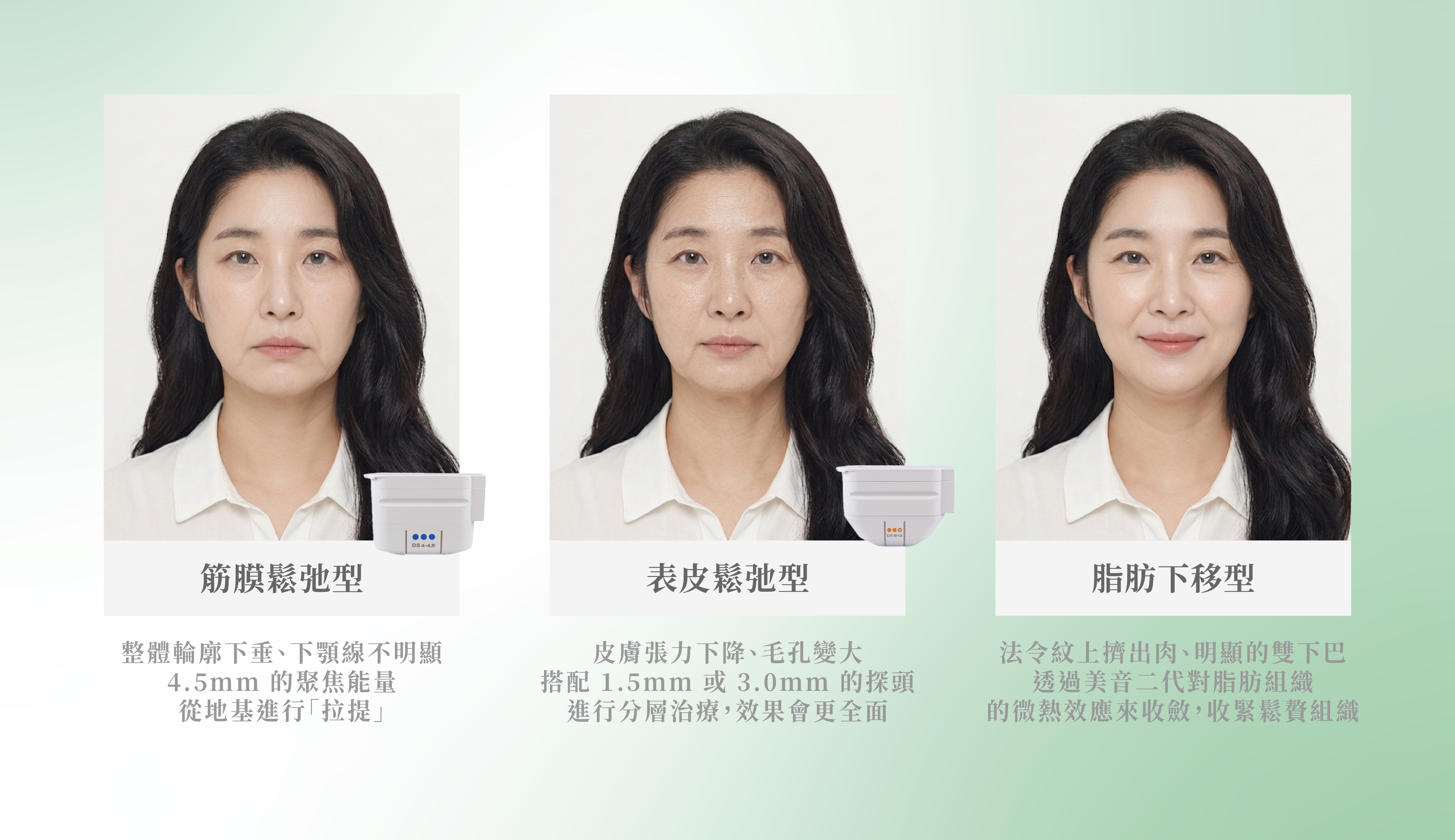 三種臉部鬆弛型態比較：筋膜鬆弛型、表皮鬆弛型、脂肪下移型