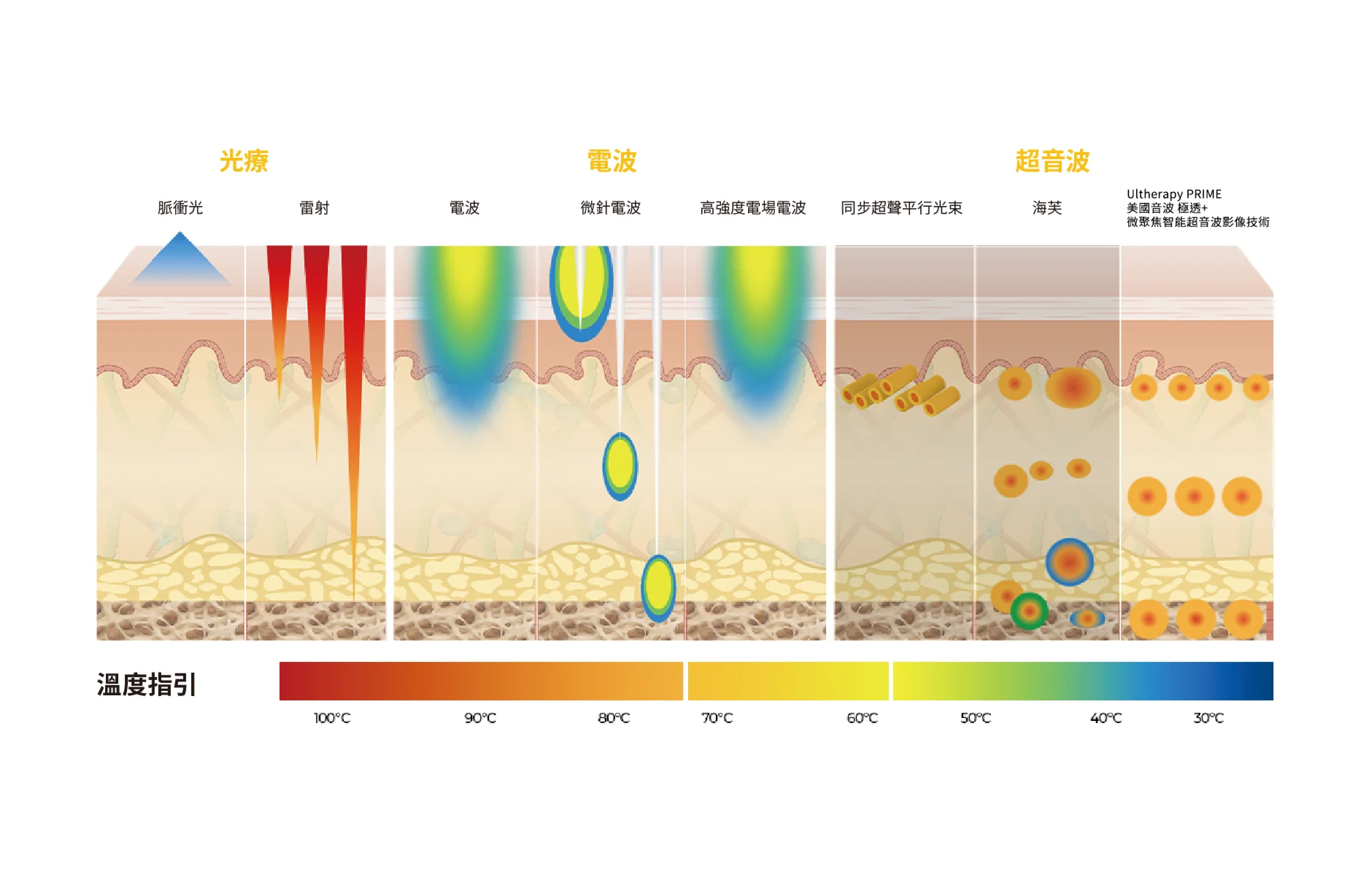 能量聚焦深度 vs 非聚焦加熱的比較圖＿辰美學